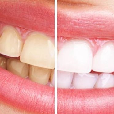  Clínica Dental Global Dentarcos blanqueamiento dental 