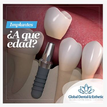  Clínica Dental Global Dentarcos implante 